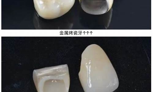 高考体内有金属,牙套算_高考牙有金属